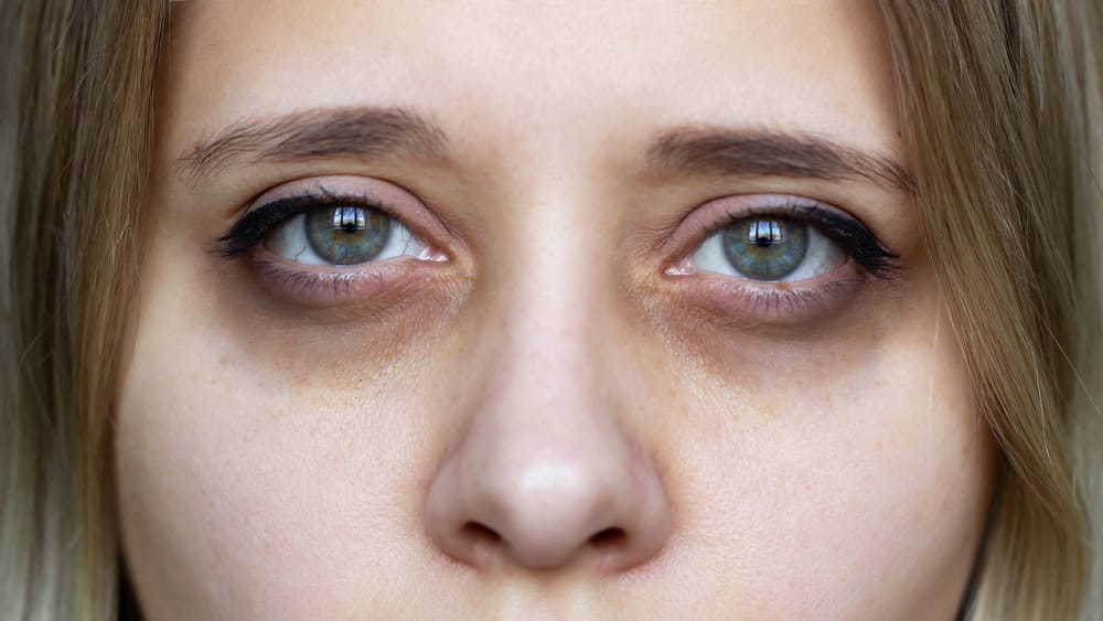How To Treat Dark Circle Under The Eyes Lumina Aesthetics