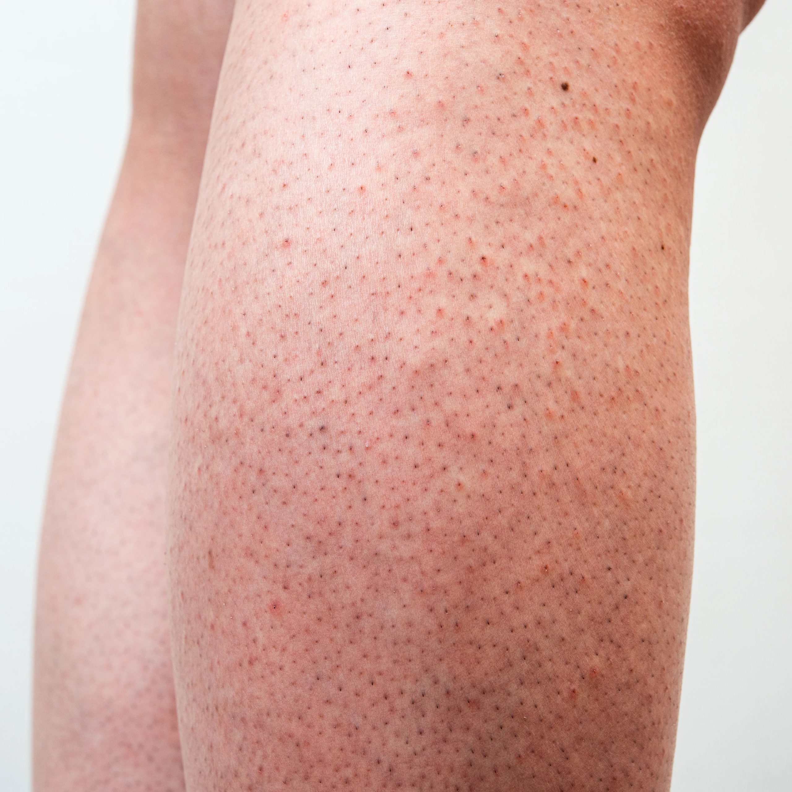 Spots On Legs: Causes, Home Remedy And Prevention  Dark spots on legs, Dark  spots on skin, Spots on legs
