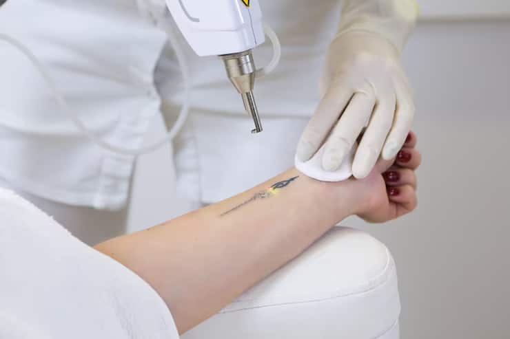 Virginia Beach Tattoo Removal: Why PicoSure Pro is THE Answer – The Skin  Chic